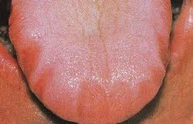 Tongue Problem